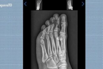 candidato-faz-teste-fisico-da-pm-com-fratura-no-pe-e-consegue-aprovacao:-‘pensei-que-nao-ia-conseguir’