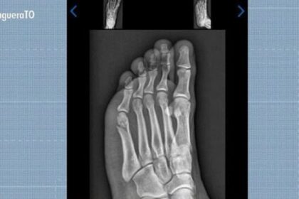 candidato-faz-teste-fisico-da-pm-com-fratura-no-pe-e-consegue-aprovacao:-‘pensei-que-nao-ia-conseguir’