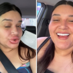 preenchimento-e-acido hialuronico:-entenda-reacao-que-deixou-maquiadora-com-labios-gigantes-e-saiba-os-riscos