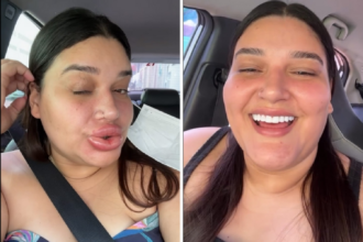 preenchimento-e-acido hialuronico:-entenda-reacao-que-deixou-maquiadora-com-labios-gigantes-e-saiba-os-riscos