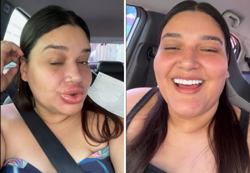 preenchimento-e-acido hialuronico:-entenda-reacao-que-deixou-maquiadora-com-labios-gigantes-e-saiba-os-riscos