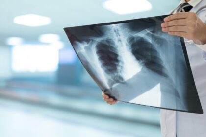 comissao-de-saude-debate-incorporacao-da-terapia-tripla-para-tratamento-da-fibrose-cistica