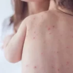 sp-confirma-2-novos-casos-de-sarampo-e-estado-soma-7-infeccoes-em-2026