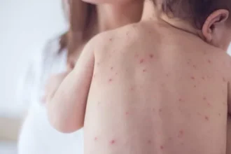 sp-confirma-2-novos-casos-de-sarampo-e-estado-soma-7-infeccoes-em-2026