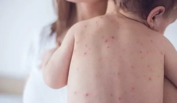 sp-confirma-2-novos-casos-de-sarampo-e-estado-soma-7-infeccoes-em-2026