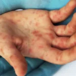 quao-perigoso-e-o-sarampo?-sintomas-para-ficar-de-olho-e-como-se-proteger