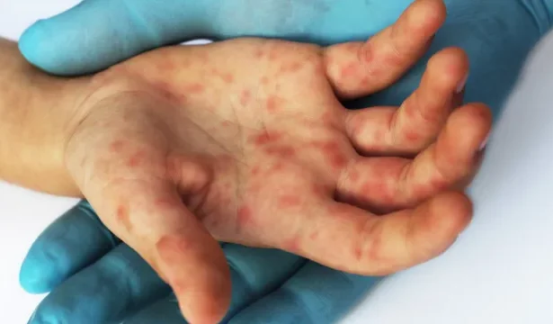 quao-perigoso-e-o-sarampo?-sintomas-para-ficar-de-olho-e-como-se-proteger