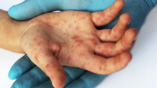 quao-perigoso-e-o-sarampo?-sintomas-para-ficar-de-olho-e-como-se-proteger
